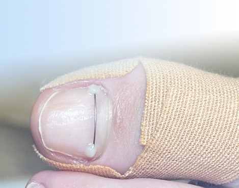 Лікування врослого нігтя Одеса