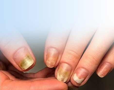 Лікування пустот під нігтями