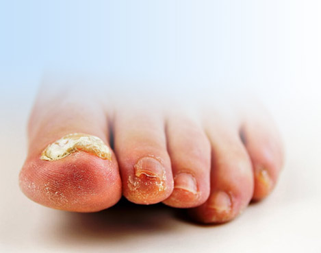 Лікування грибка нігтів в Одесі