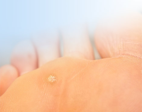 Видалення бородавок Одеса