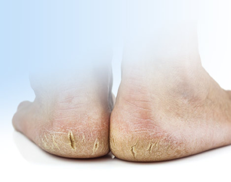 видалення мозолів в Одесі