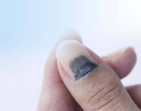 Лікування травм нігтя у Одесі